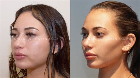 Buccal Fat Removal Egypt at Ella Hogarth blog