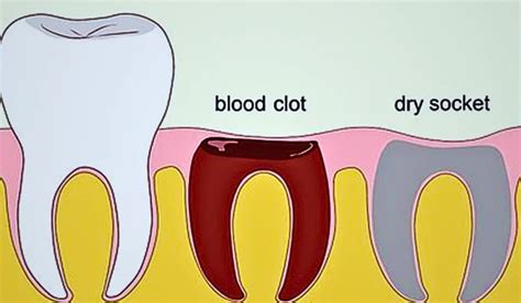 Tooth Socket After Extraction 的图像结果