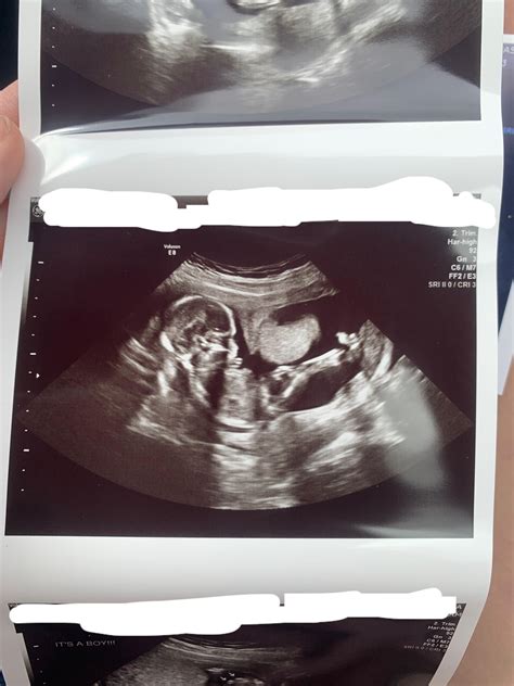 Bicornuate pregnancy ultrasound : r/bicornuateuterus