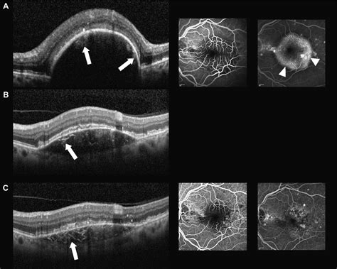 High-resolution optical coherence tomography of subpigment epithelial structures in patients ...