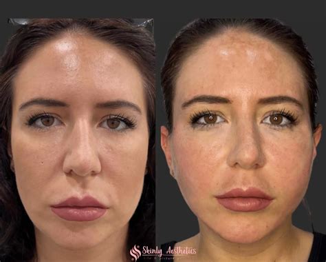 PDO Thread Lifting - Before and After Results at Skinly Aesthetics