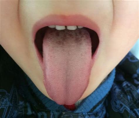 舌头发黄是什么症状 舌头表面发黄是什么原因导致 有咳嗽症状_第二人生