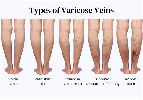 Best Varicose Veins Treatment Doctor in Mumbai - Dr. Amit