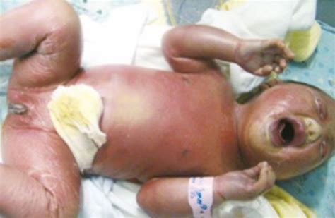 火棉胶婴儿可以活多久，存活率与正常婴儿无异 - 求医网