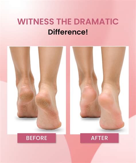 Urban Yog Callus Remover – UrbanYog