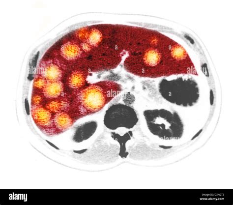 CT scan slices showing extensive metastatic liver cancer Stock Photo - Alamy