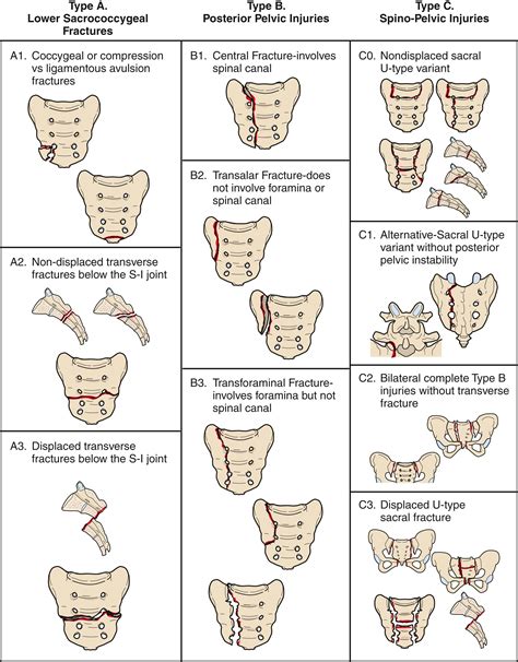 Management of Sacral Fractures - Clinical Tree