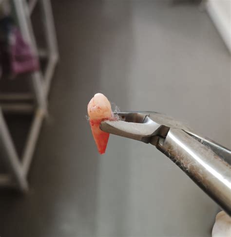 Image result for Basic Tooth Extraction