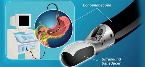 Endoscopic Ultrasound In Hyderabad | Dr. Kiran Peddi
