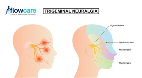Exploring the Link Between Trigeminal Neuralgia and Facial Pain ...