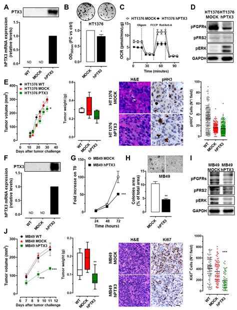 Long Pentraxin-3 Follows and Modulates Bladder Cancer Progression
