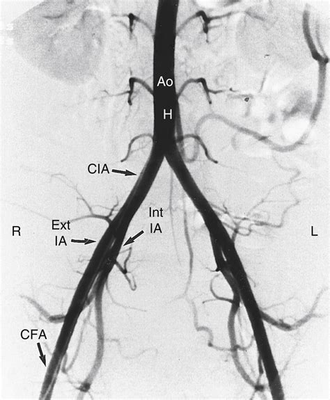 Vascular Anatomy of the Pelvis - Clinical Tree