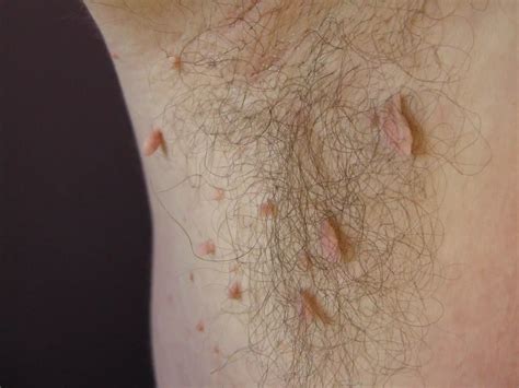 Skin Tag: Causes, Symptoms, and Treatment Options