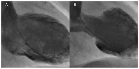 Takotsubo Syndrome and Cancer: Pathophysiological Links and Clinical ...
