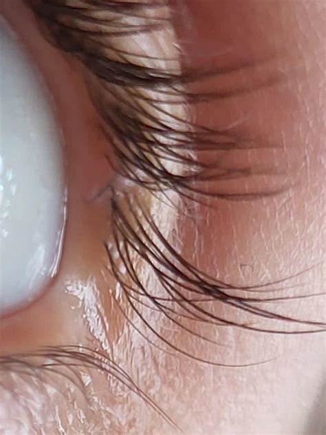 remove ingrown eyelash : r/howto
