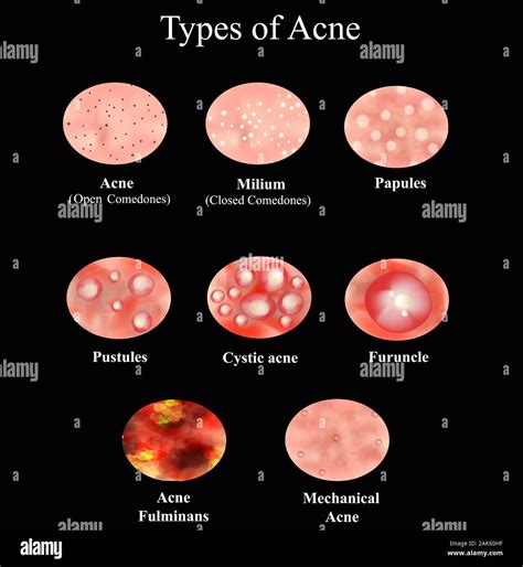 Types of Acne Skin inflammation. Pimples, boils, whitehead, closed comedones, papules, pustules ...