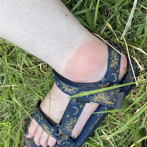 Itchy Rash After Yellow Jacket Sting at Sandra Miles blog