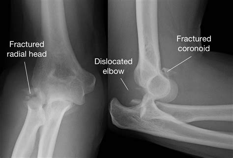 Elbow Fracture Dislocation