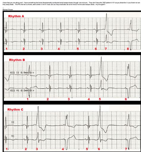 Ventricular Escape Beats and Fusion Beats with Interpretation by Dr Ken ...