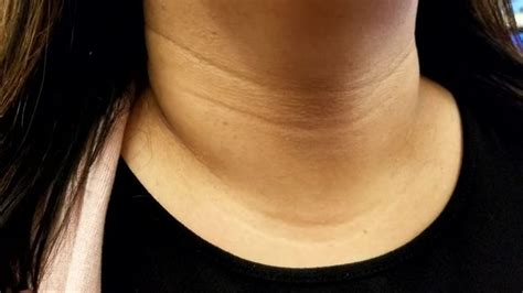 How to get rid of 'tech neck' — creases in your neck that aren't caused ...
