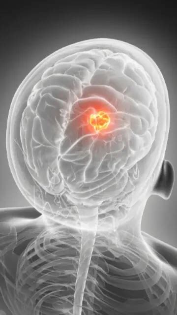 5 Key Signs Of Brain Tumors