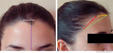 Widows Peak Hairline Solutions