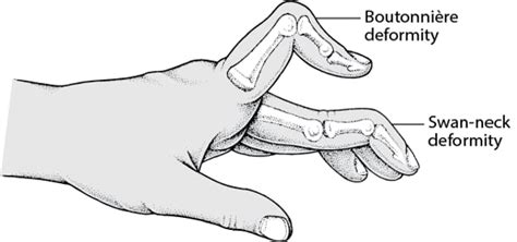 Image result for Hand Dysfunction