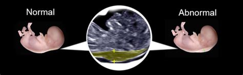 NT Scan During Pregnancy - What Every Expecting Parent Should Know ...