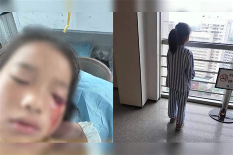 8岁女孩被钢珠射中左眼失明后续：男孩家属答应垫付10万医药费又反悔