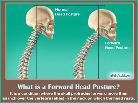 Image result for Forward Neck Position Tight Muscle Front