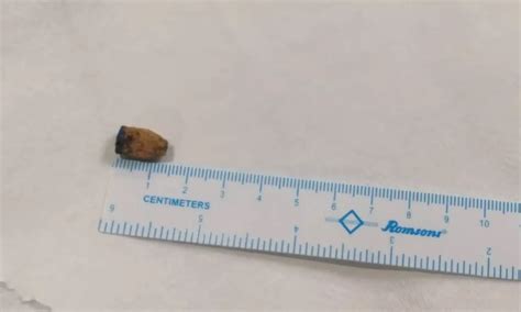 Doctors at KIMS Hospital Remove Pen Cap Stuck in Lungs for 21 Years