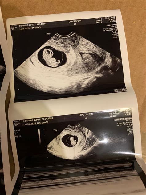 6 Week Ultrasound Hidden Twin