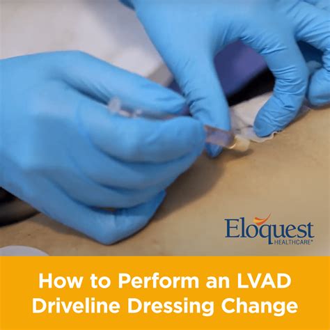 How to Perform an LVAD Driveline Dressing Change – Eloquest Healthcare, Inc.