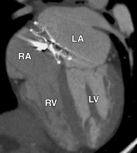 MDCT Evaluation After Closure of Atrial Septal Defect with an Amplatzer Septal Occluder | AJR