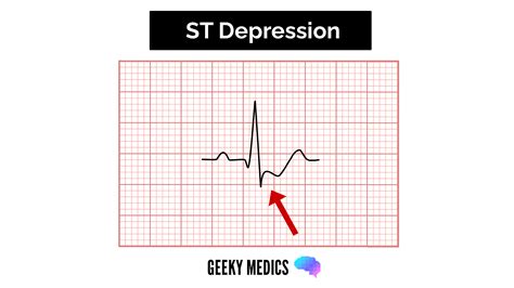 How to Read an ECG | ECG Interpretation | EKG | Geeky Medics