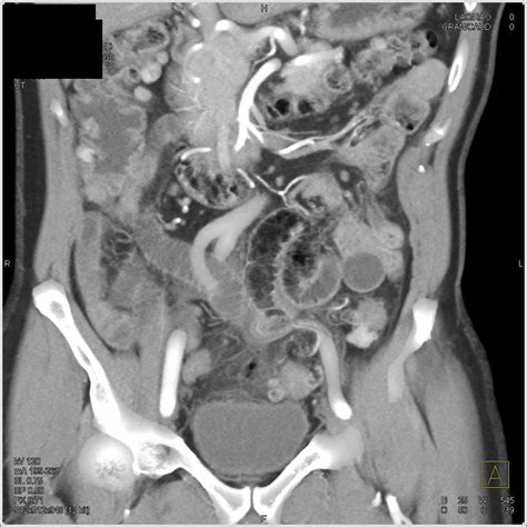 Focal Sigmoid Diverticulitis with Perforation - Colon Radiology Case ...