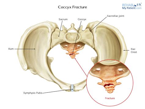 Tail Bone Fracture Signs