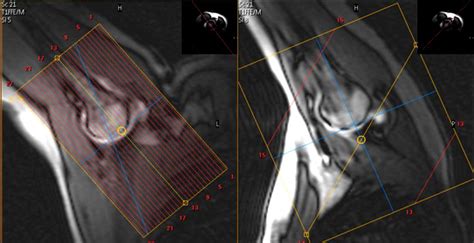 Mr Arthrogram Shoulder 的图像结果
