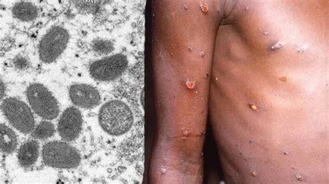 Drivers of taxi and auto in which monkeypox-infected patient had ...