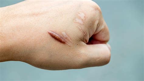 केलोइड के लक्षण, कारण और इलाज | Keloid Symptoms Causes Treatment in ...