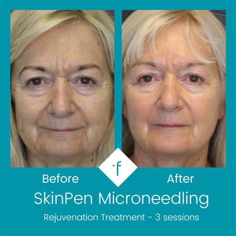 How Much Is Skinpen Treatment at Ali Winston blog