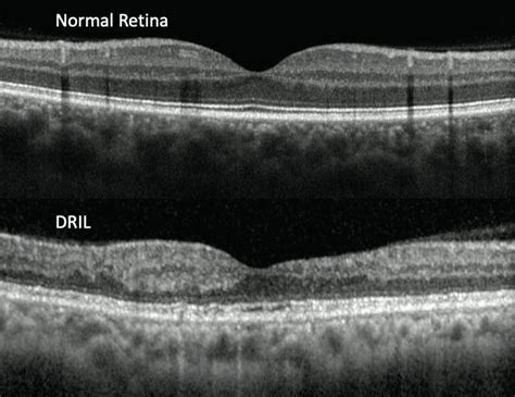Tips for Recognizing and Understanding OCT Biomarkers - Modern Optometry - layers of retina oct