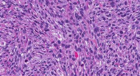 What is sarcoma? | MyPathologyReport