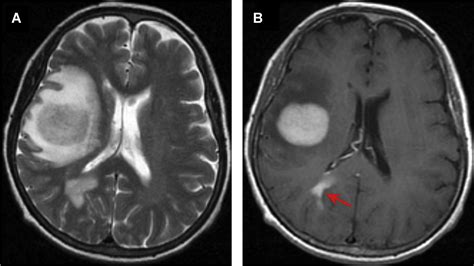Adult Primary Brain Neoplasm, Including 2016 World Health Organization Classification ...