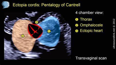 Pentalogy Of Cantrell