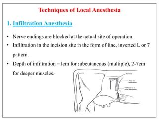 Local Infiltration Anesthesia 的图像结果