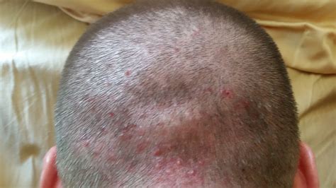 Acne On Scalp Side – Seborrheic dermatitis – Altmersleben