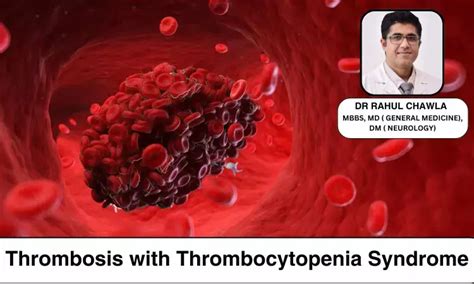 Decoding Thrombosis with Thrombocytopenia Syndrome (TTS): Covid Vaccine ...