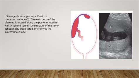 Placenta types and grading | PPTX