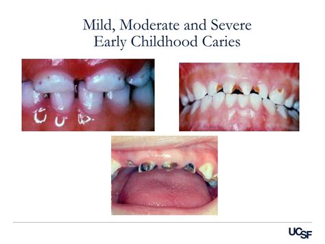 PPT - Early Childhood Caries Risk Assessment & Prevention Seminar ...